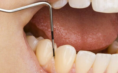 Periodoncia : Tratamientos de las encías