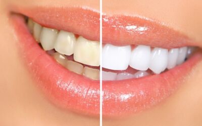 Proceso de Blanqueamiento Dental Láser