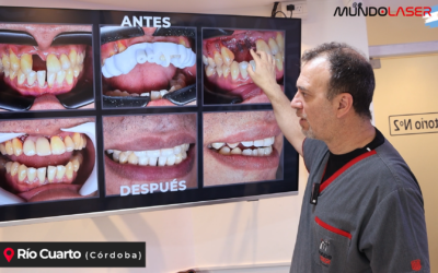 Dientes fijos en el día con Implantes Monofásicos